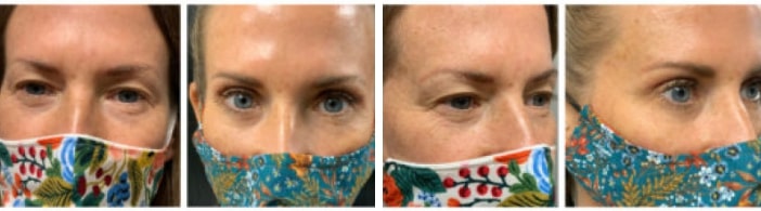 Blepharoplasty Dallas-Fort Worth TX