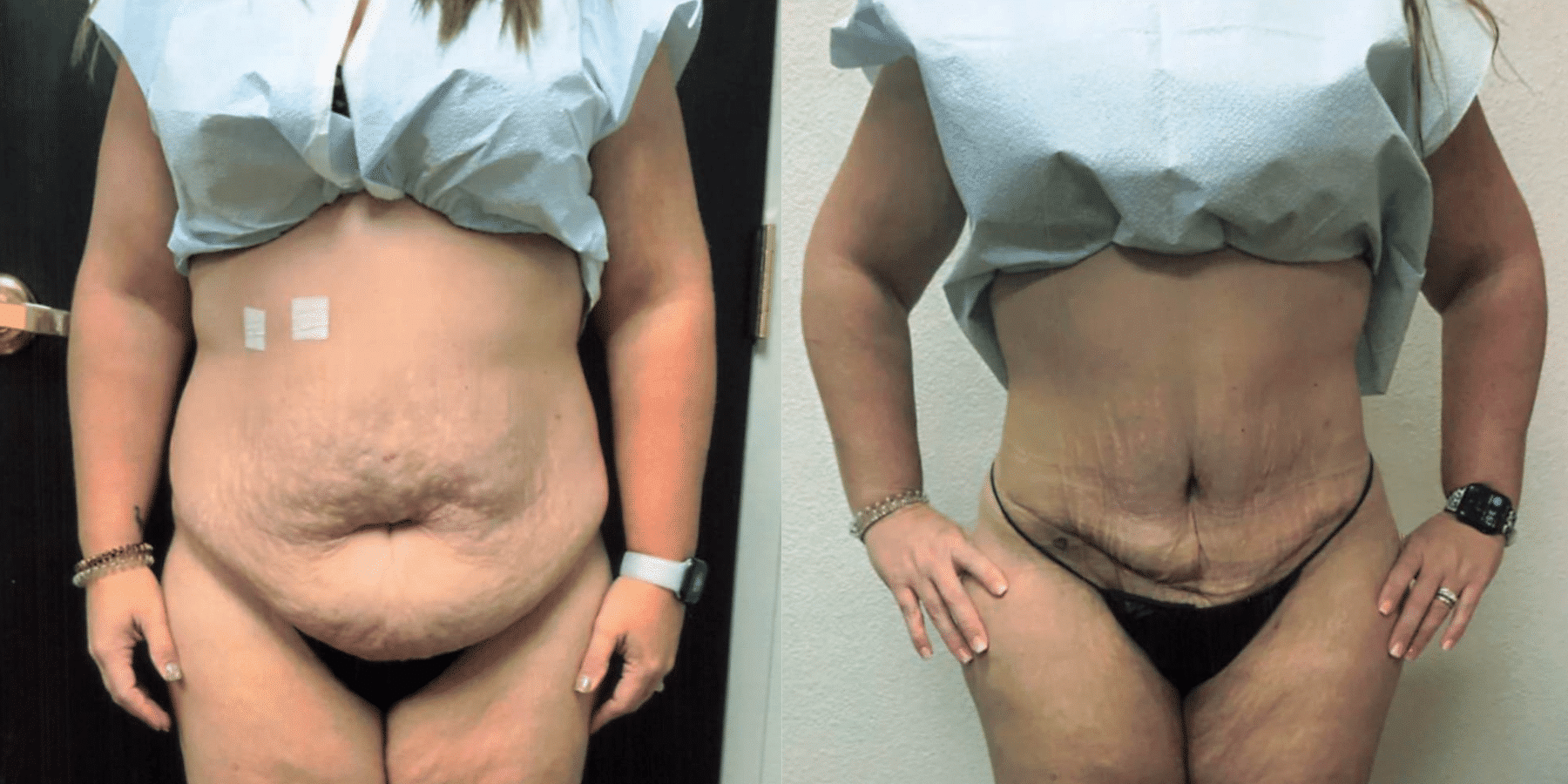 Before And After Tummy Tuck Lewisville TX