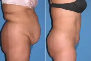 Abdominoplasty Tummy Tuck Gallery